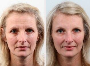 Antes&Despues-Fillers-1