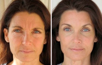 Antes&Despues-Fillers-3