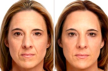 Antes&Despues-Fillers