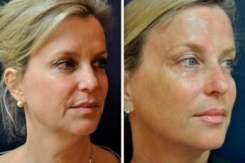 Antes&Despues-Ultherapy-1