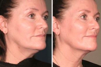 Antes&Despues-Ultherapy-3