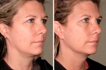Antes&Despues-Ultherapy-4