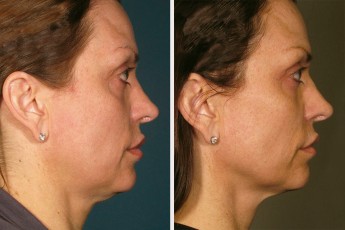 Antes&Despues-Ultherapy