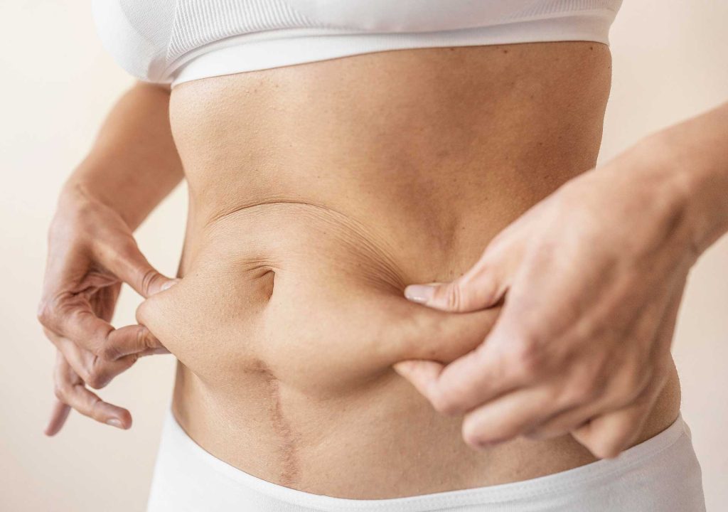 ¿Por qué no bajo la panza con dieta y ejercicio?