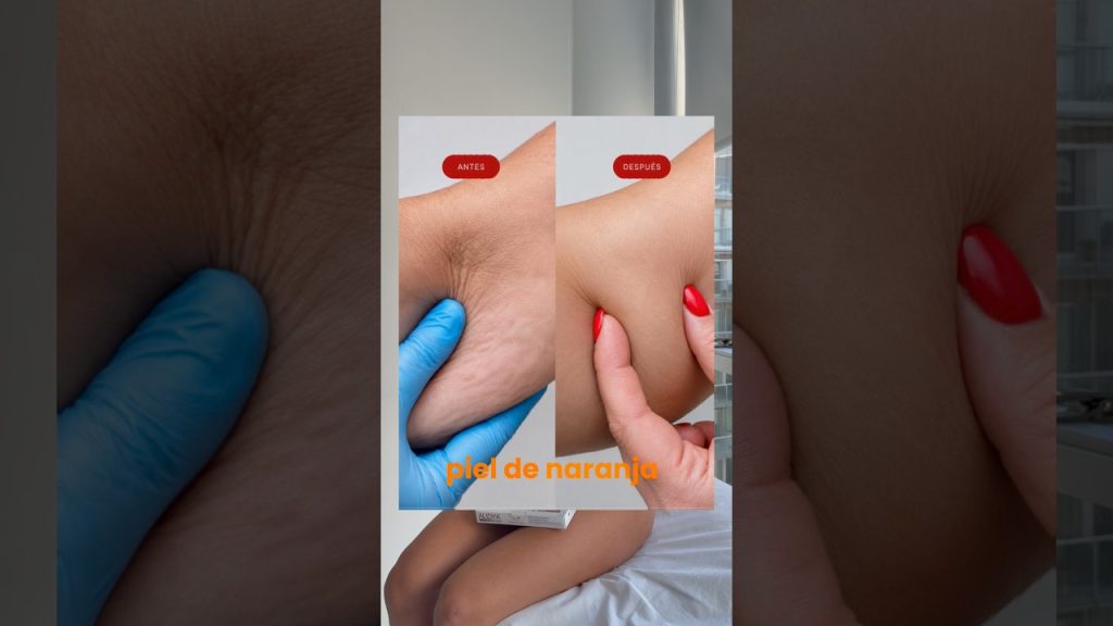 Alidya para celulitis: el testimonio de una paciente