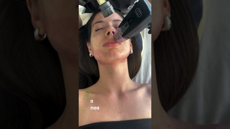 Morpheus8 + Exosomas: estimulación profunda y reparación celular