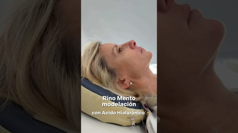Rino Mento modelación con Ácido Hialurónico: perfil armónico sin cirugía